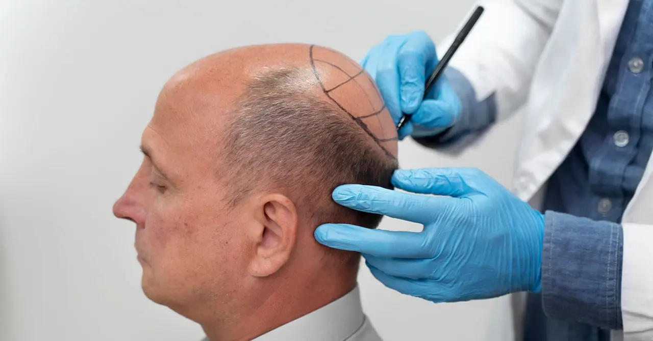 best hair transplant techniques